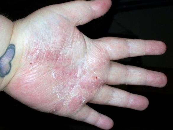 psoriasis in the palms