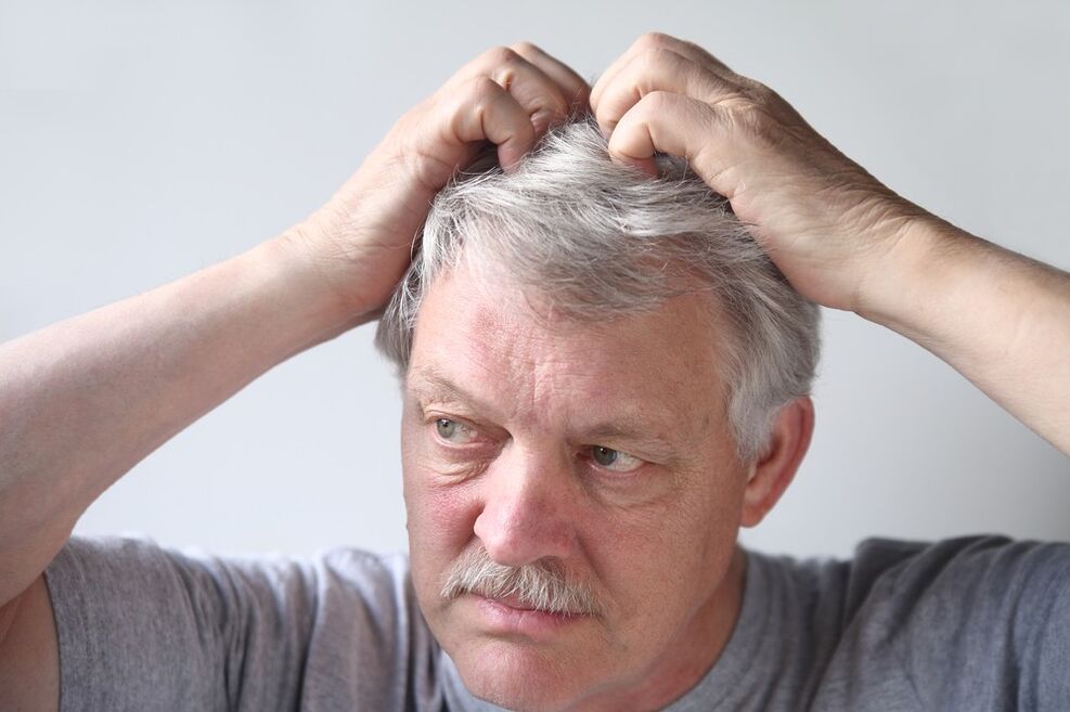 signs of psoriasis on the head