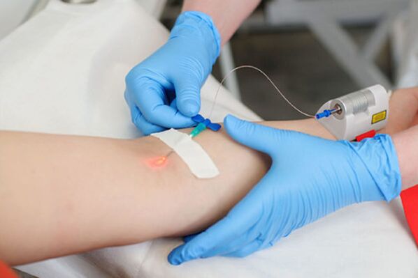 Intravenous laser treatment for psoriasis in the legs