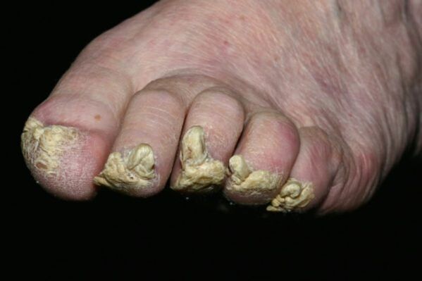psoriasis of the toenails