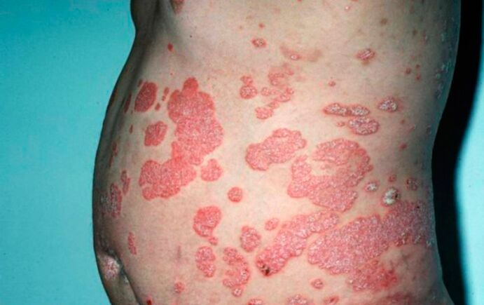 signs of psoriasis in the body