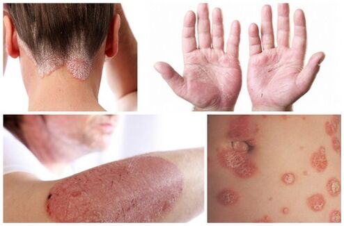 signs of psoriasis in the body