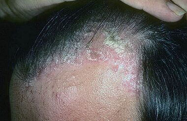 psoriasis on the head picture 1