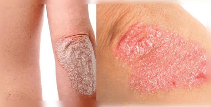 What psoriasis looks like on the skin