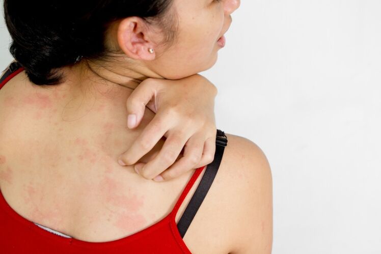 signs and symptoms of psoriasis