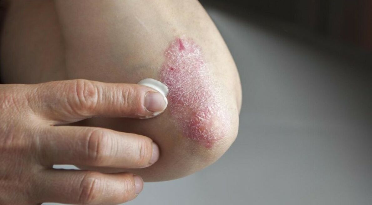 Psoriasis, which affects the skin, treatment involves the use of ointments