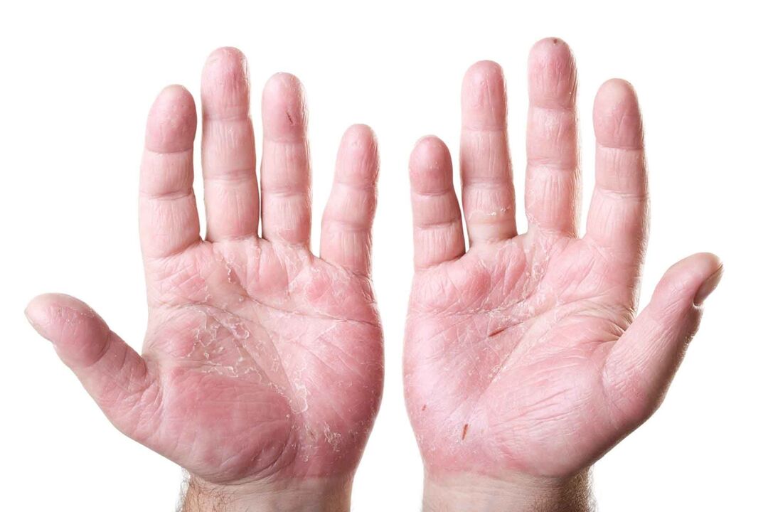 types of psoriasis on palms