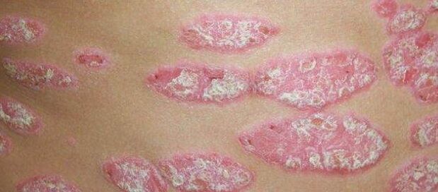 Progressive stage of psoriasis
