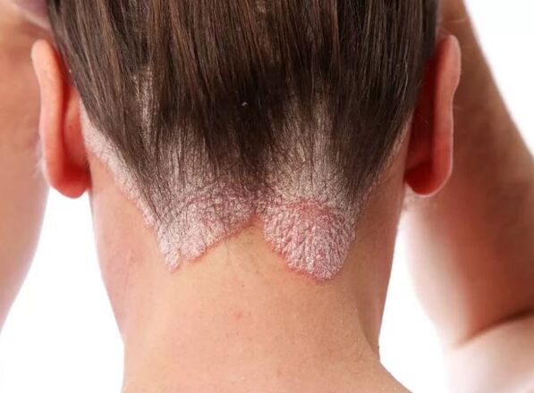 Psoriaki eritroderma