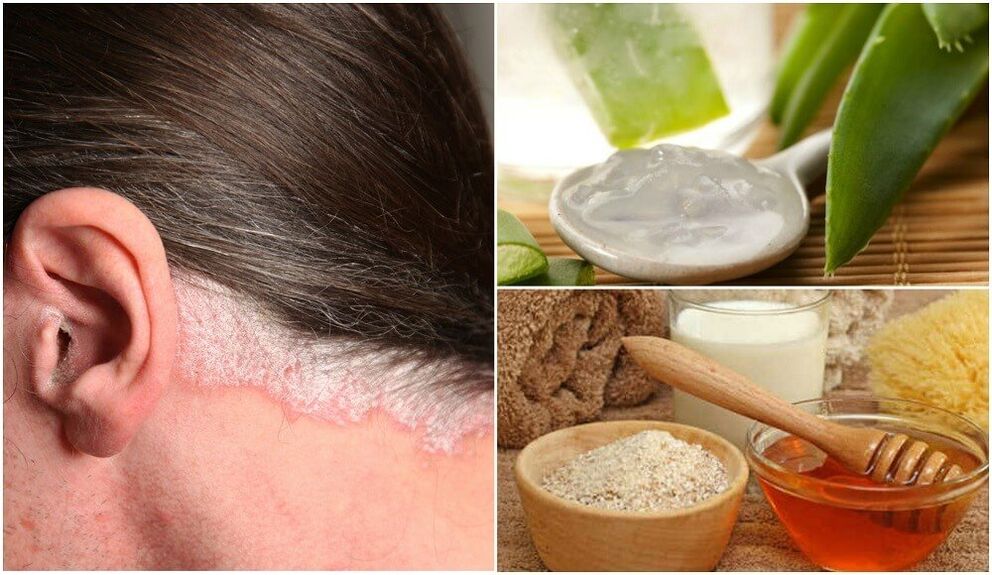 Treatment of Psoriasis with people's treatment