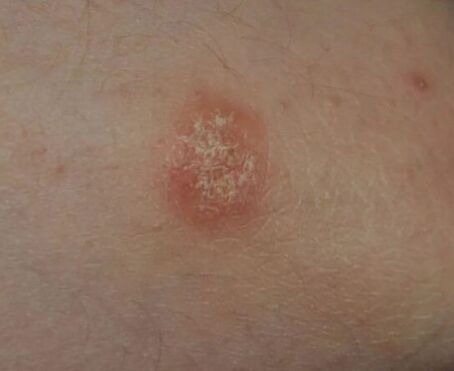 Psoriasis spot