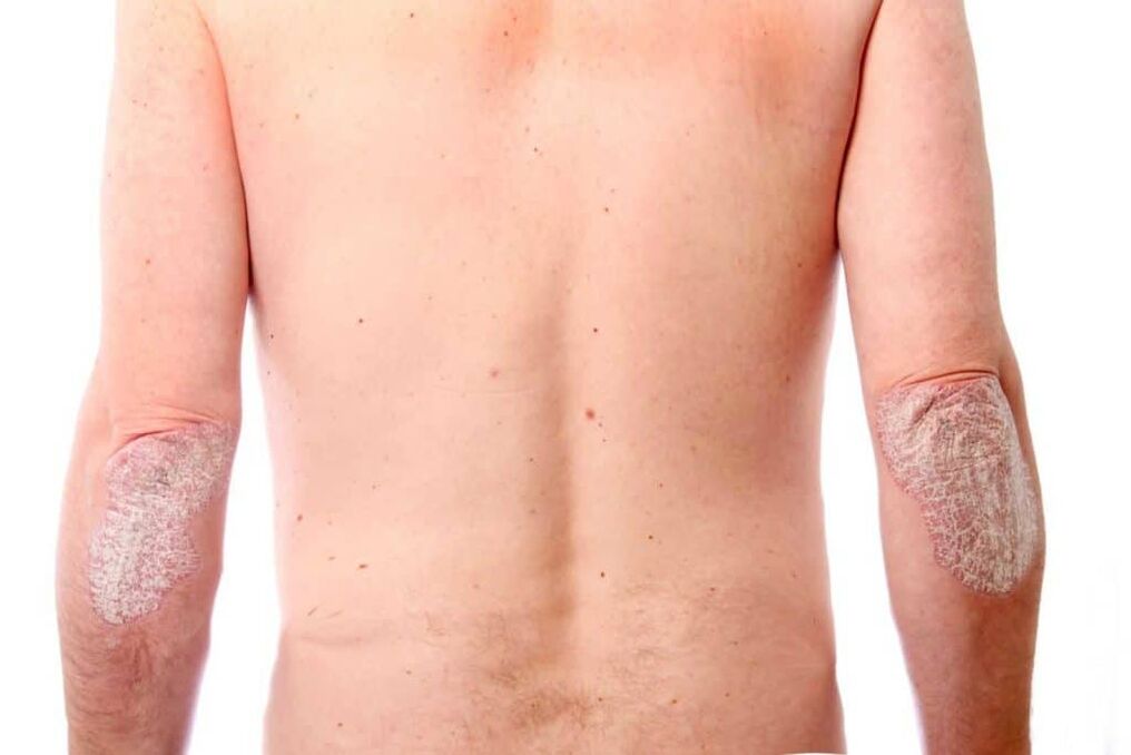 The second stage of the psoriasis