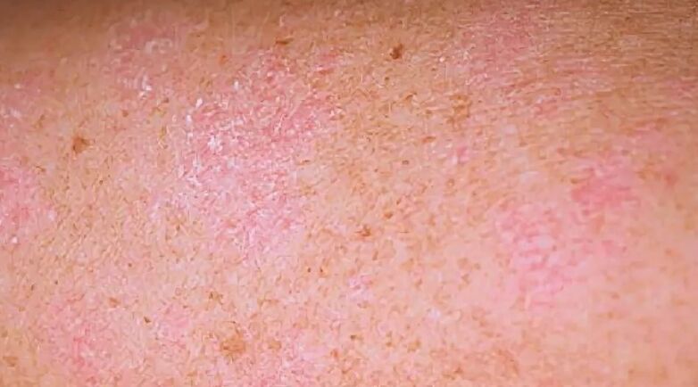 Regressive phase of psoriasis