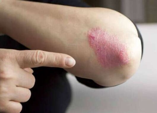 Stationary stage of psoriasis