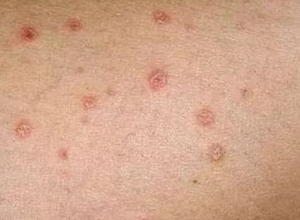 Psoriasis of the initial stage
