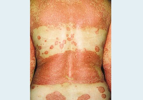 Genital psoriasis