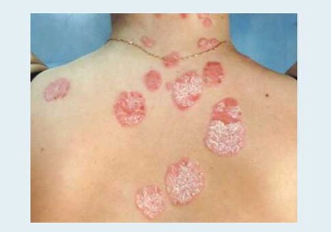 Ordinary psoriasis
