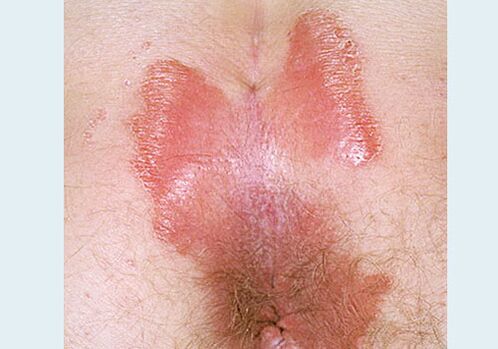 The approaching psoriasis