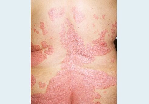 The psoriasis of the back