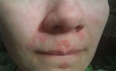 Psoriasis on their face