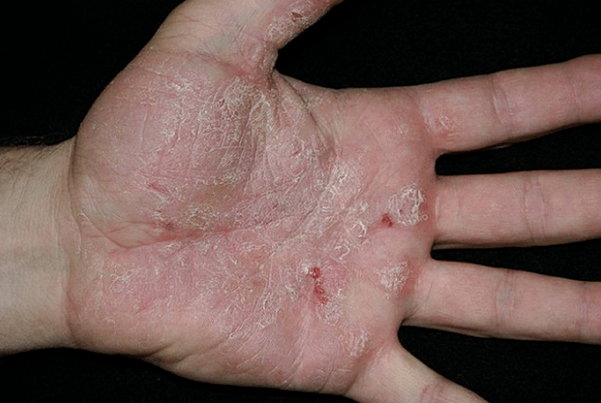 Psoriasis in his hand