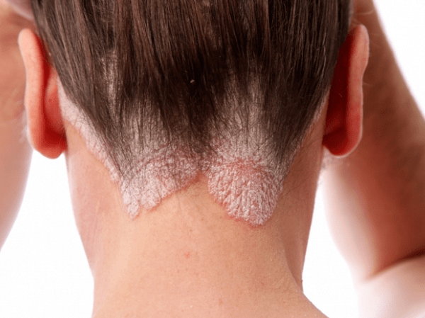 Psoriasis in the head