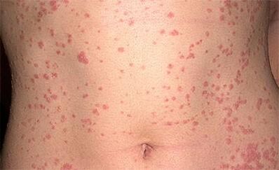 Psoriasis in the body