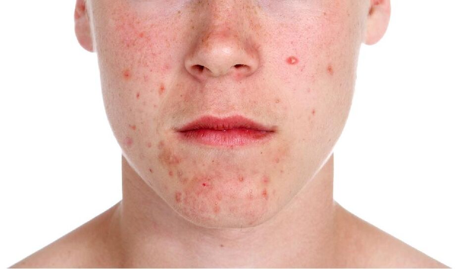 Psoriasis on their face