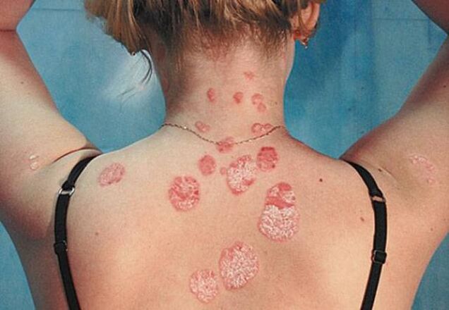 Psoriasis in the back