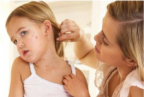 Photo by the initial stage of psoriasis