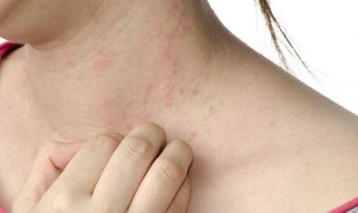 advanced stage psoriasis treatment