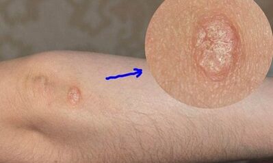 development stages of psoriasis