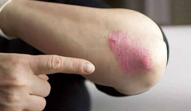 stationary phase of psoriasis development