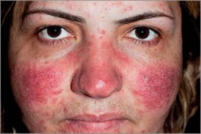 Seborrheic psoriasis