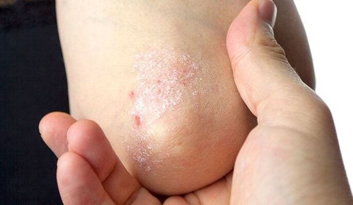 early signs of psoriasis