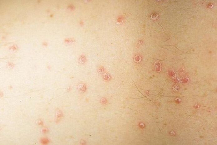 symptoms of spot psoriasis