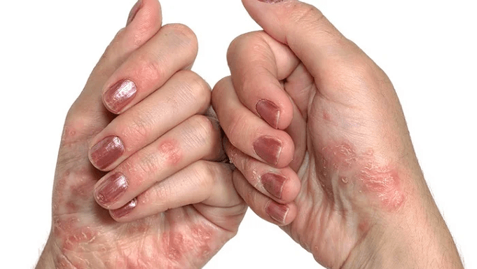 The initial stage of psoriasis