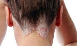 psoriasis form and stages of development