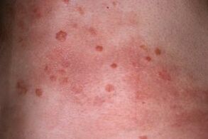 picture of psoriasis on the skin